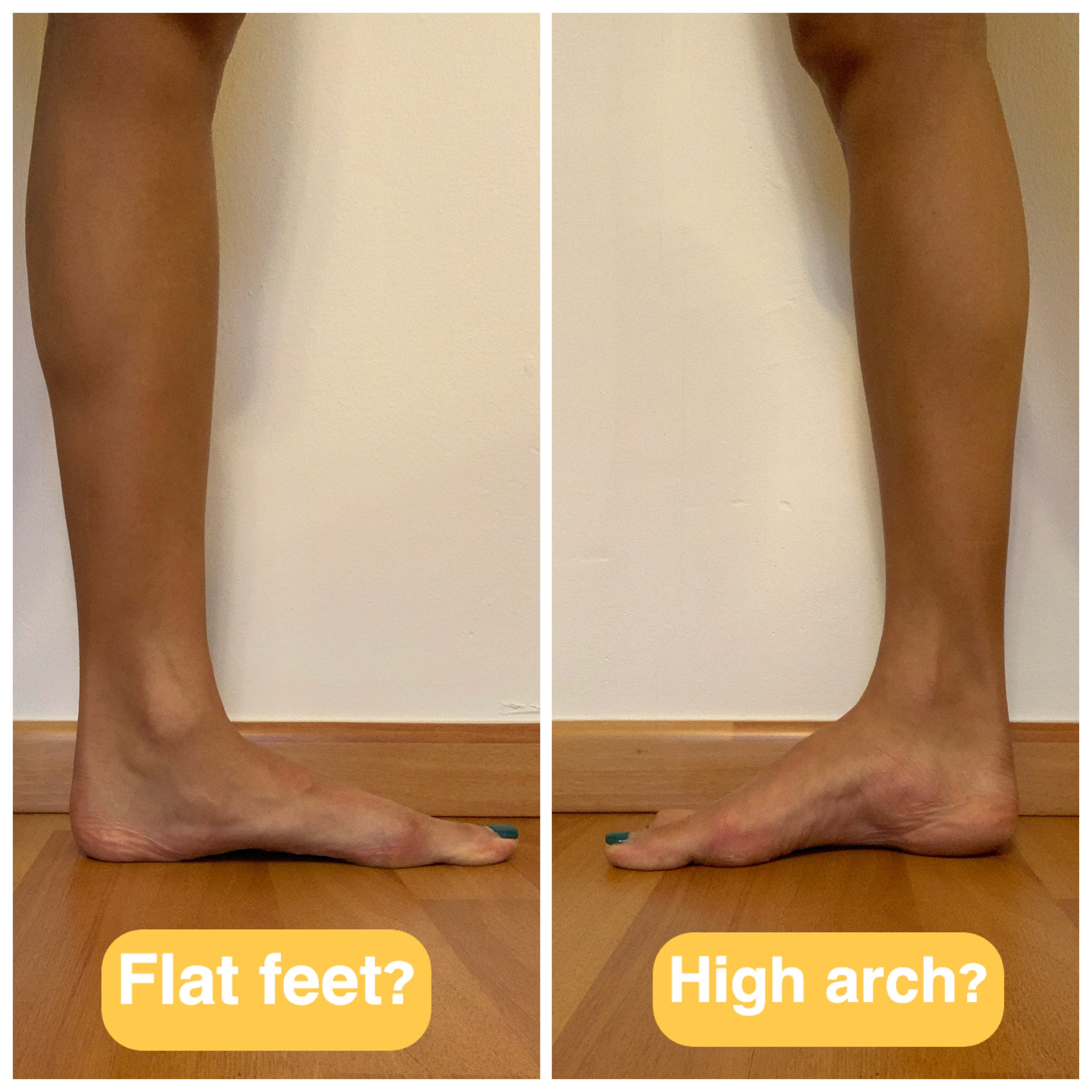 Foot Postures: What It Means For Your Feet?